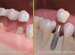 Dental Implants