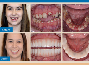 Full Mouth Rehabliation