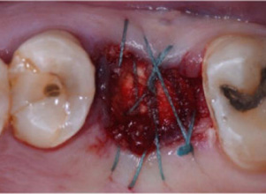 Surgical Tooth Extraction